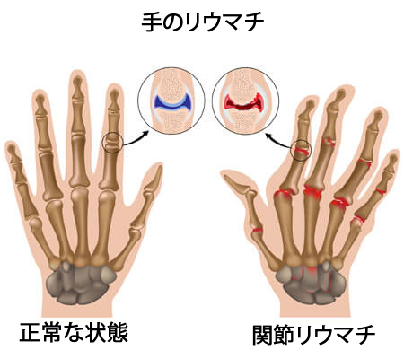 関節リウマチ
