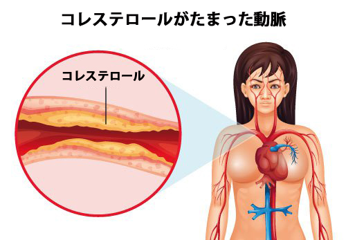 コレステロールをコントロールするには? コレステロールをコントロールするには?