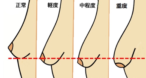 胸が垂れる原因となる5つの悪習慣