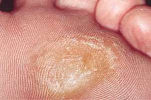 足にできるタコとウオノメの自然療法7種