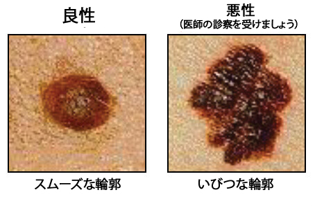 ほくろ1