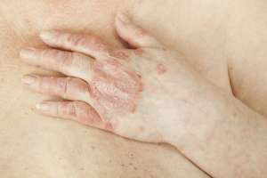 皮膚が剥がれ落ちる病気/乾癬(かんせん)は治る?
