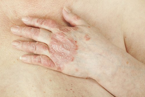 皮膚が剥がれ落ちる病気/乾癬(かんせん)は治る？