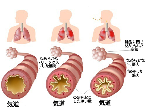 慢性喘息やアレルギーへの対処法 慢性喘息やアレルギーへの対処法