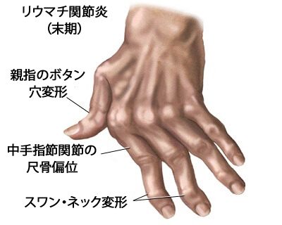 手の関節炎を治療する/7つの自然療法