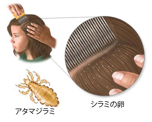 シラミを除去する自然療法