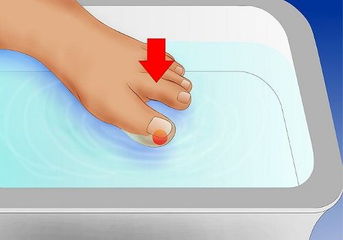 足の巻き爪 を正しく治す方法