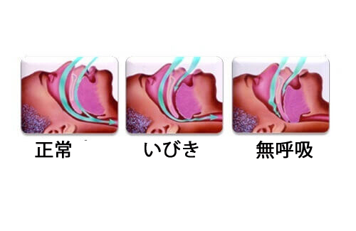 無呼吸