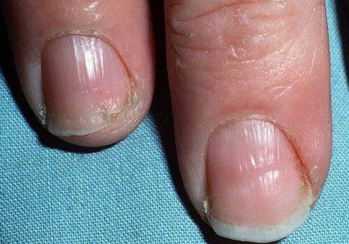 甲状腺異常：割れやすい爪