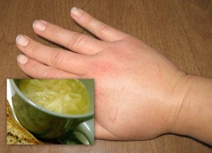 1ヶ月で体液貯留を治療