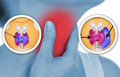 甲状腺に悪影響を及ぼす/可能性のある/8つの生活用品 甲状腺に悪影響を及ぼす/可能性のある/8つの生活用品