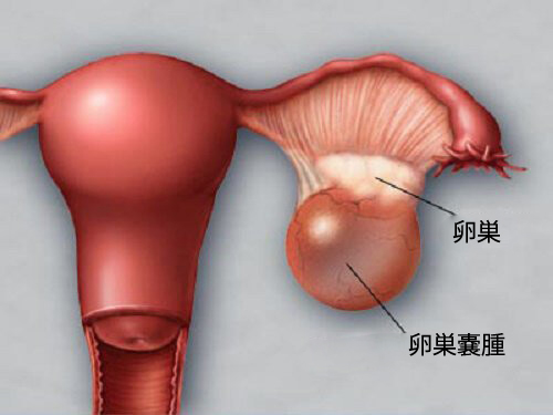 卵巣の健康に影響を与える5つの事柄 卵巣の健康に影響を与える5つの事柄