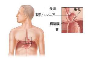 裂孔ヘルニアについて