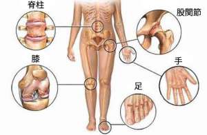 もう関節痛に悩まない!5つの自然療法