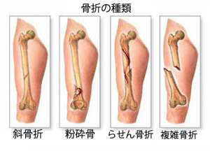 知っておくべき原発性骨腫瘍の主な症状5つ