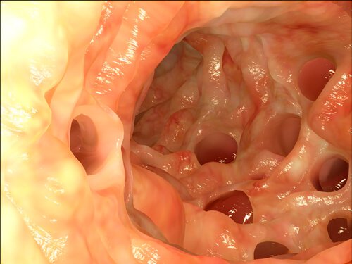 大腸憩室症 けいしつしょう と憩室炎 症状と自然療法 みんな健康