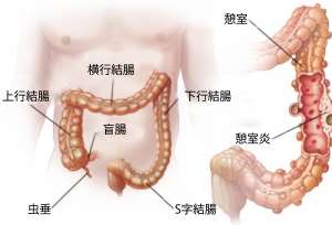 大腸憩室症(けいしつしょう)と憩室炎:症状と自然療法