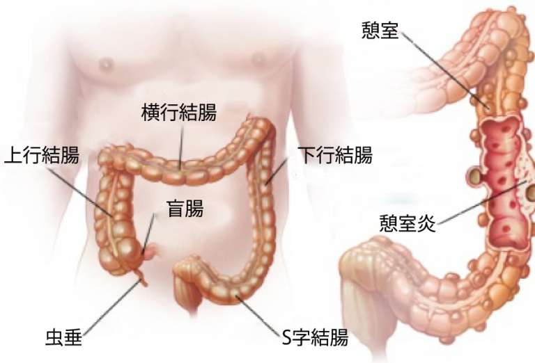 大腸憩室症（けいしつしょう）と憩室炎：症状と自然療法