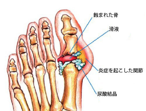 炎症を起こした関節