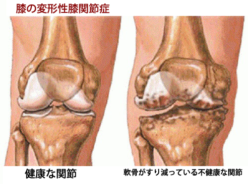 変形性膝関節症