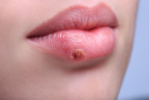 口唇ヘルペスを予防・治療する自然な方法