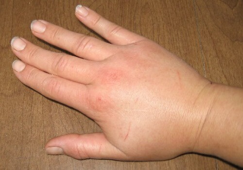 1-swollen-hands-1