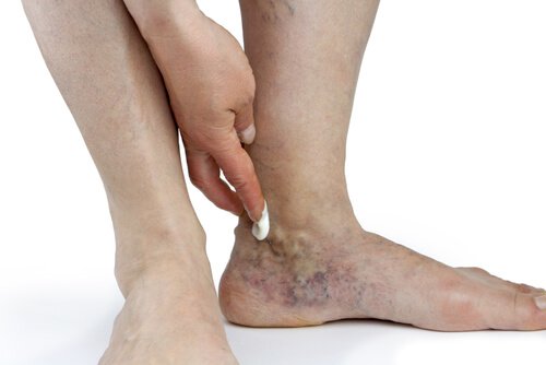 2-ankle-swelling
