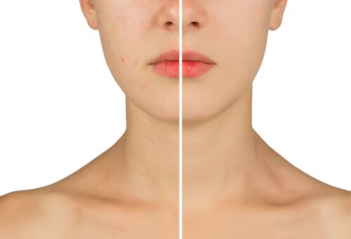 2-fight-acne