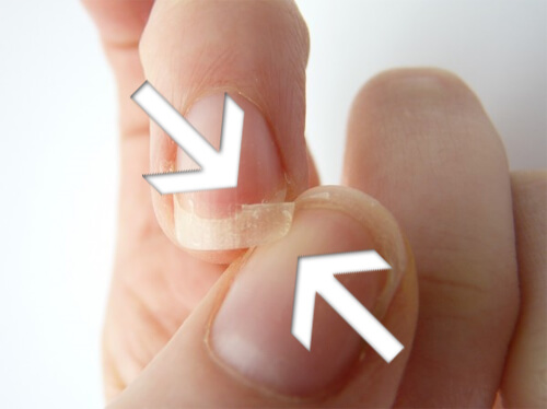 5-brittle-nails