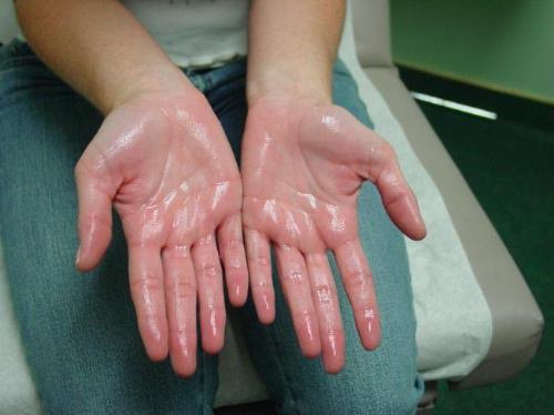 3-sweaty-palms