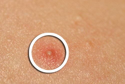 4-acne