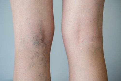薬草茶で下肢静脈瘤を治療