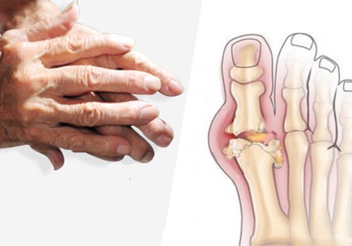 2-arthritis