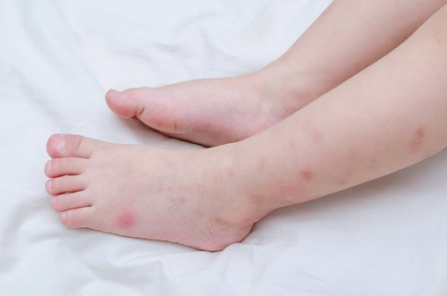 5-multiple-bites