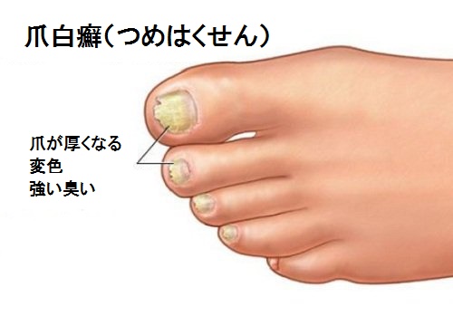 Hongos-en-las-uñas