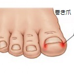 巻き爪