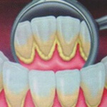 歯垢を自然に取りのぞく方法 歯垢を自然に取りのぞく方法