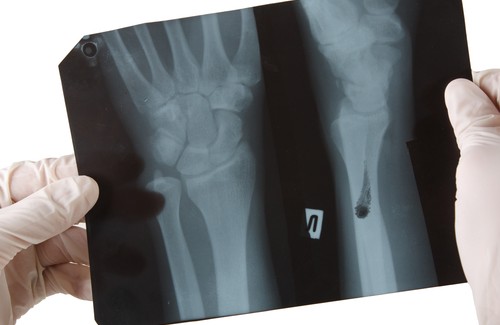 健康な骨のために控えるべき食品