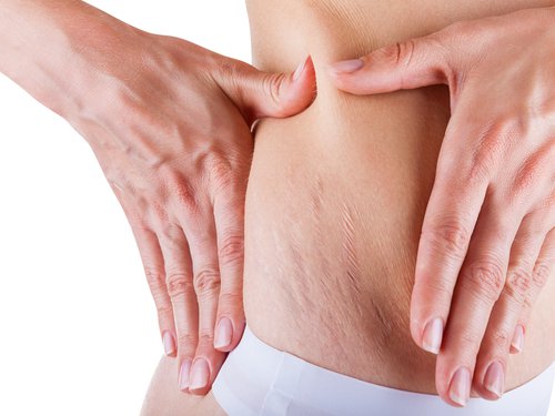 2-stretch-marks