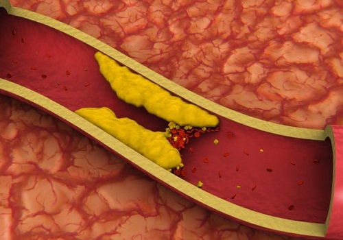 Cholesterol