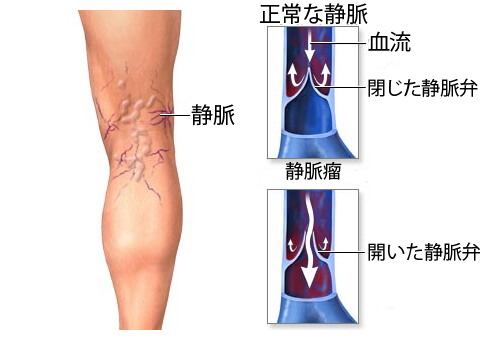 冷たいシャワーで静脈瘤予防