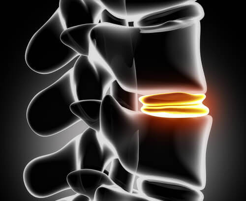 What-is-a-herniated-disc