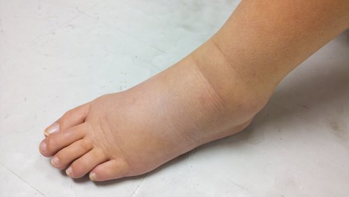 足のむくみ