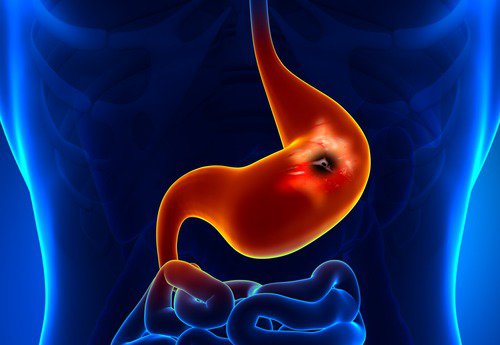 stomach-ulcer