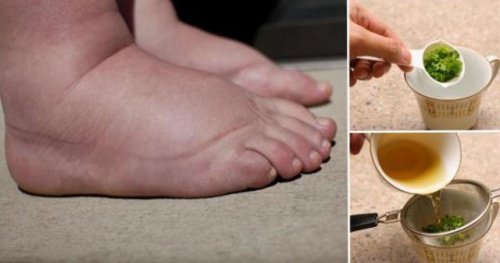 1-swollen-feet