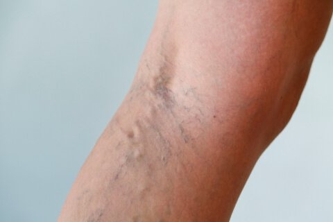 2-varicose-veins-1