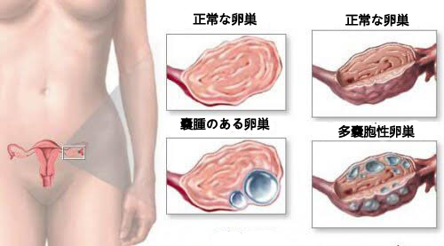 女性が知っておくべき卵巣嚢腫のこと