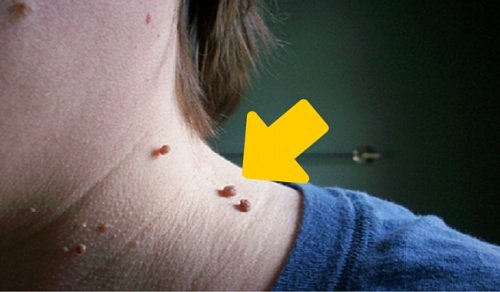スキンタッグを自然に取り除く6つの方法