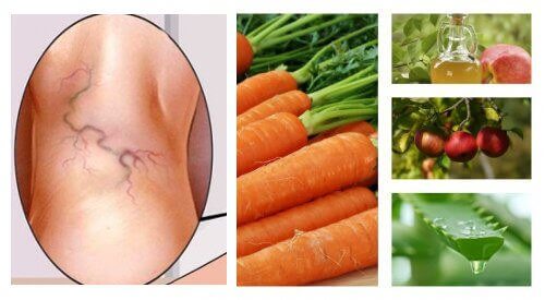 静脈瘤に効果抜群!3つの自然療法