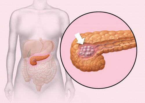 すい臓がん：５つの初期症状